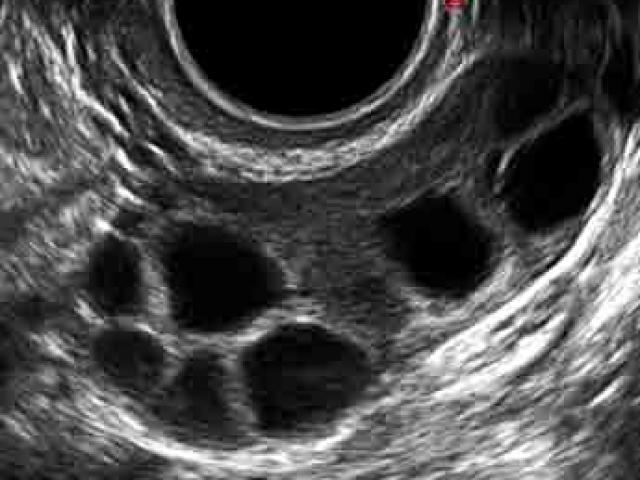 US of stimulated ovary (several follicles) - กุลพัฒน์การแพทย์ สหคลินิก US of stimulated ovary (several follicles) - กุลพัฒน์การแพทย์ สหคลินิก