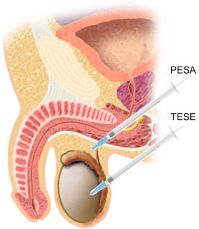 Surgical Sperm Recovery (SSR)- กุลพัฒน์การแพทย์ สหคลินิก Surgical Sperm Recovery (SSR)- กุลพัฒน์การแพทย์ สหคลินิก