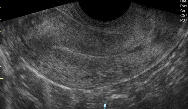 การอุลตราซาวด์ผ่านทางช่องคลอด - กุลพัฒน์การแพทย์ สหคลินิก