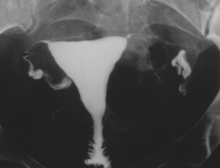 การฉีดสีเพื่อดูท่อนำไข่และมดลูก (Hysterosalpingogram/HSG) - กุลพัฒน์การแพทย์ สหคลินิก