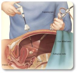 การผ่าตัดผ่านกล้องทางหน้าท้อง (Laparoscopy) - กุลพัฒน์การแพทย์ สหคลินิก การผ่าตัดผ่านกล้องทางหน้าท้อง (Laparoscopy) - กุลพัฒน์การแพทย์ สหคลินิก