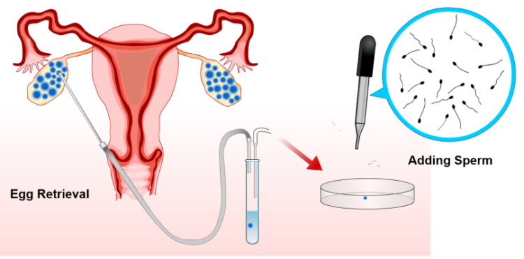 การเก็บไข่ที่สุกจากฝ่ายหญิงและการผสมกับอสุจิ - กุลพัฒน์การแพทย์ สหคลินิก